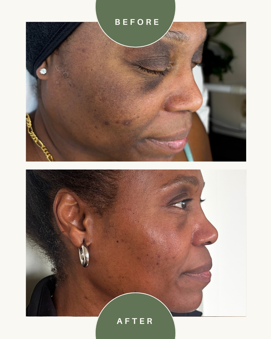 Side-by-side comparison of a woman's face before and after skincare treatment, showing improved skin clarity and texture.