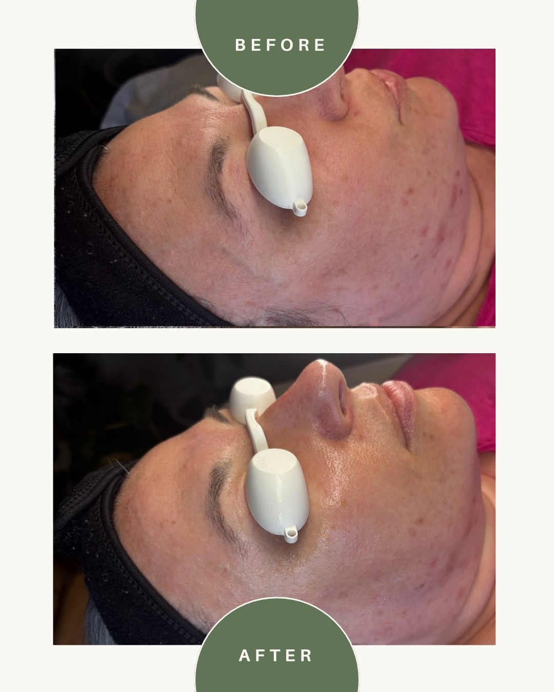 Side view of a person's face before and after skincare treatment, showing improved skin condition, with a green label indicating 'BEFORE' and 'AFTER'.