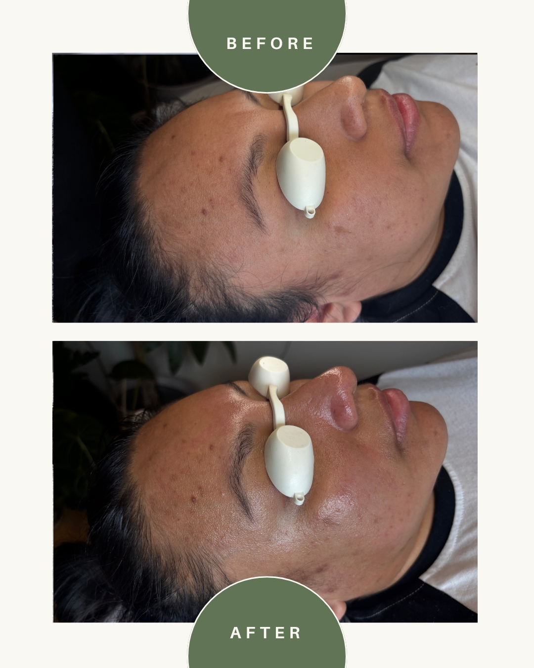 Side view of a woman with eye protection, showing before and after skincare treatment, with clear skin in the after image.