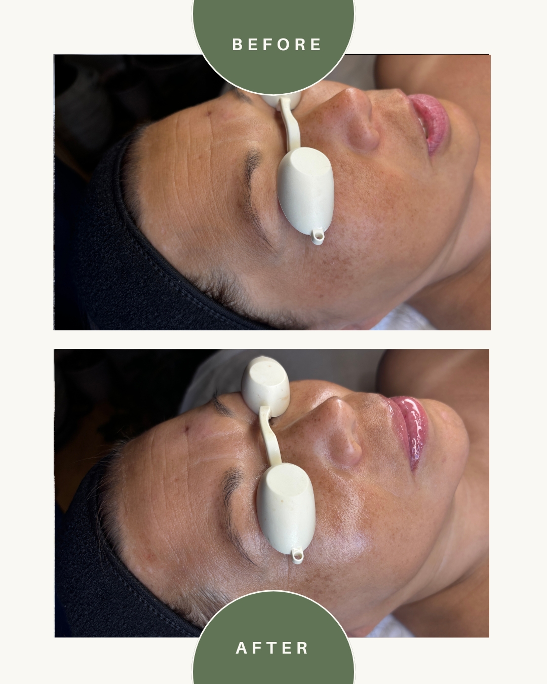 Side view of a woman receiving a facial treatment with a device, before and after results, with green labels 'BEFORE' and 'AFTER'.