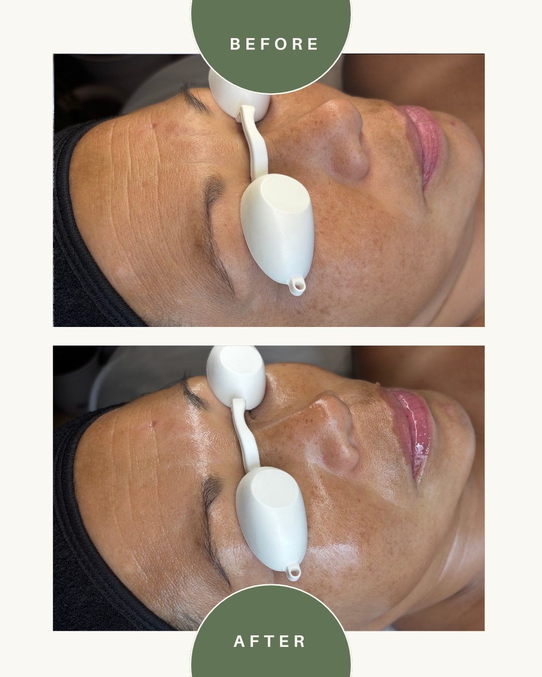 Side-by-side comparison of a person's face before and after a skincare treatment, showing improved skin appearance.