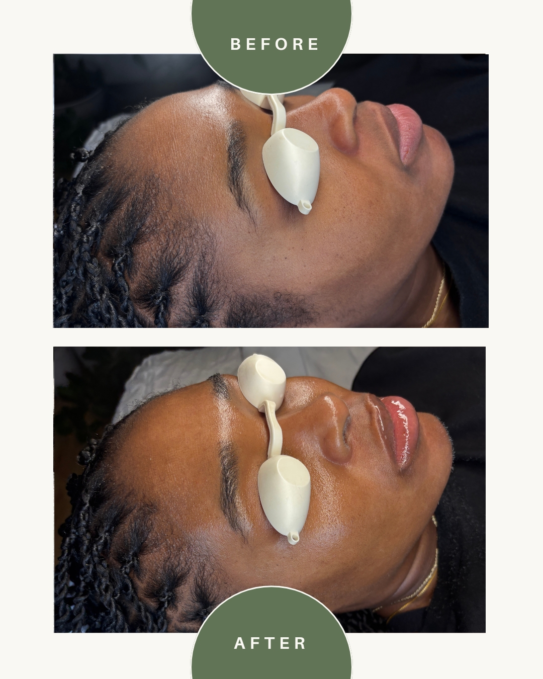 Side view of a woman receiving a facial treatment with a device on her face, before and after images, neutral expression.