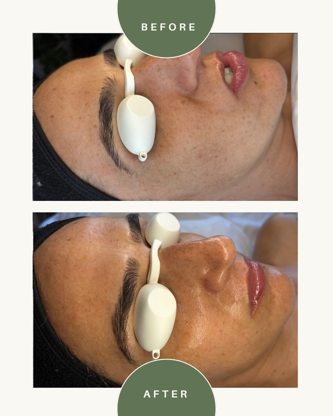 Side view of a woman's face before and after skincare treatment, showing improved skin clarity and texture, with a white device on her face.