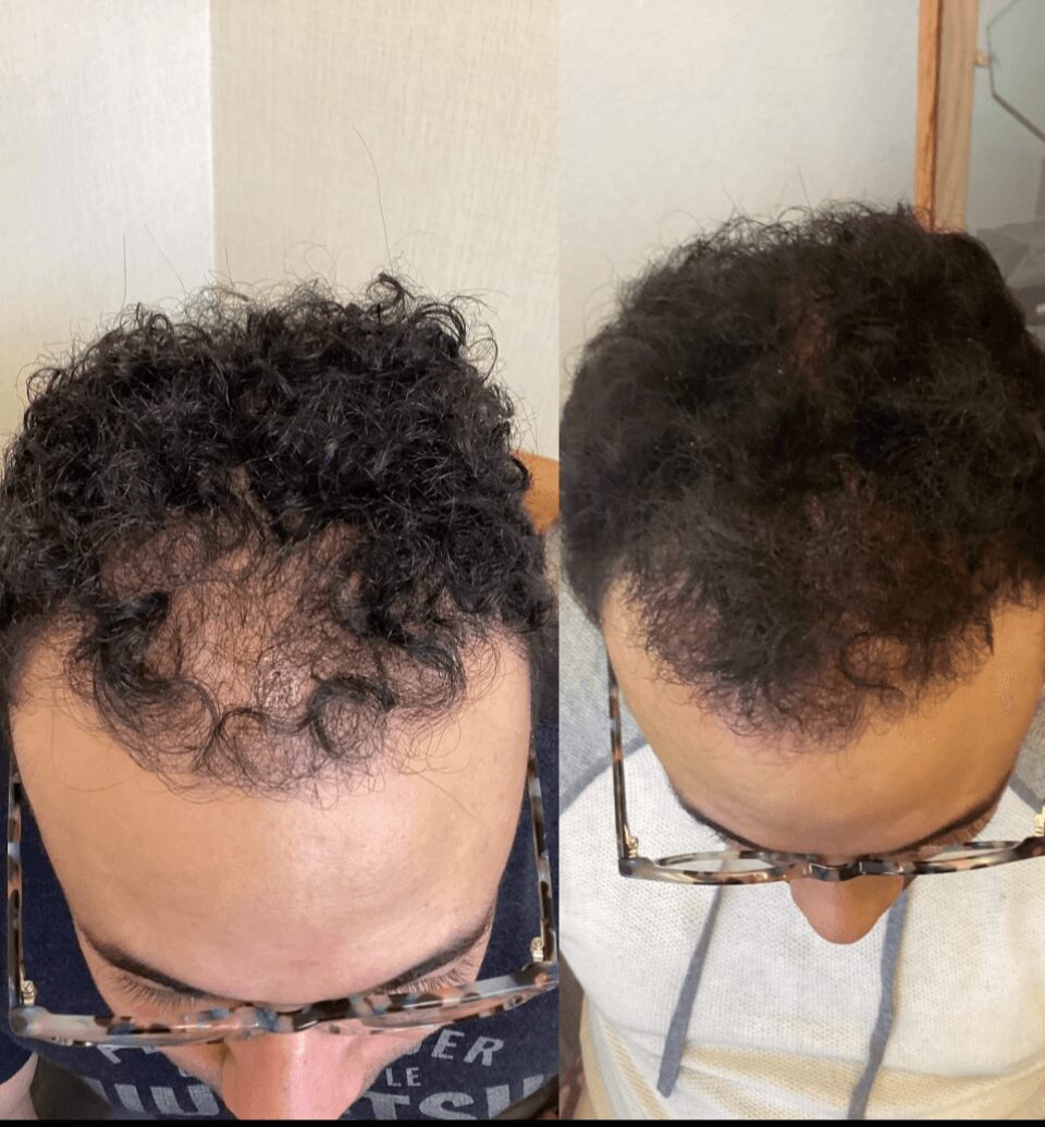 Comparison of two people with different hairstyles, viewed from above, showing hair texture and hairline.