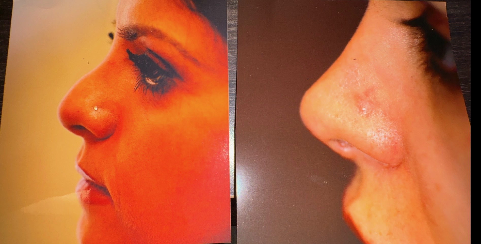Side view of a person's nose and face before and after a procedure, showing changes in skin and shape.