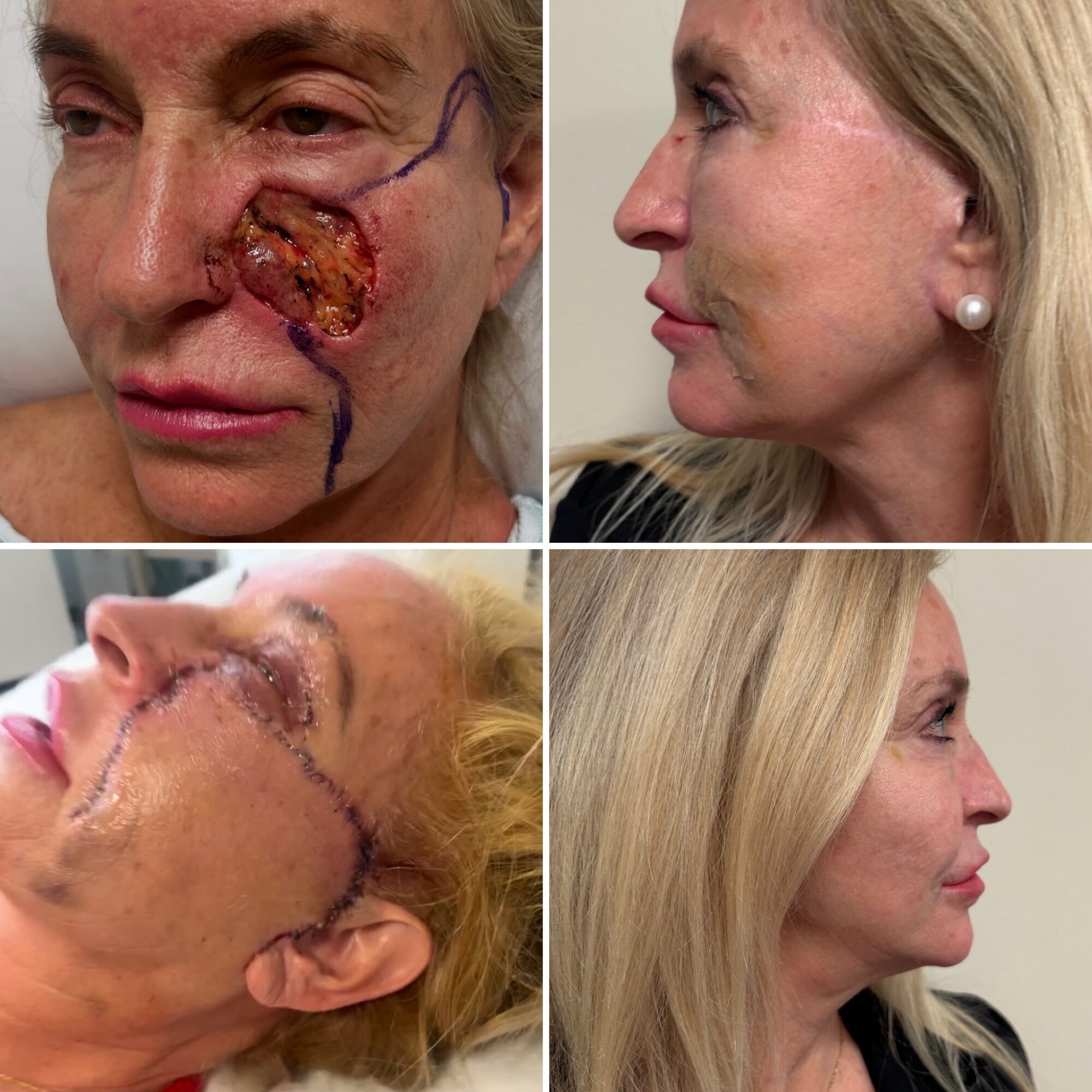 Before and after images of a woman's face showing surgical scar healing and skin improvement, side views. Word count: 20.
