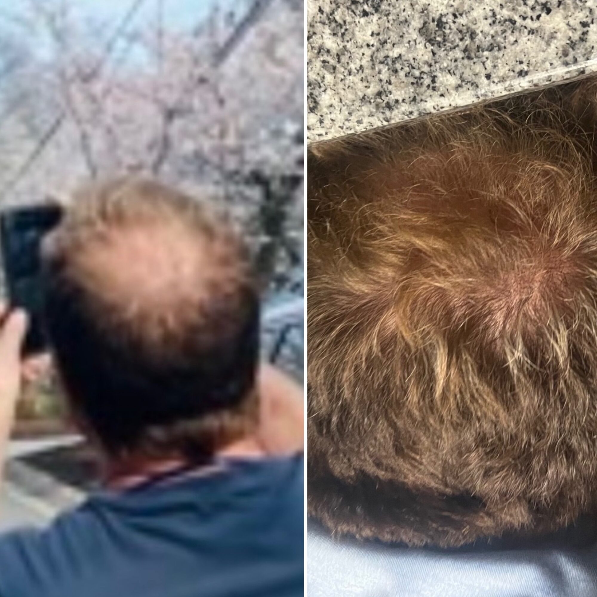 Comparison of hair loss and hair growth on a person's head, showing a bald spot and a fuller area.